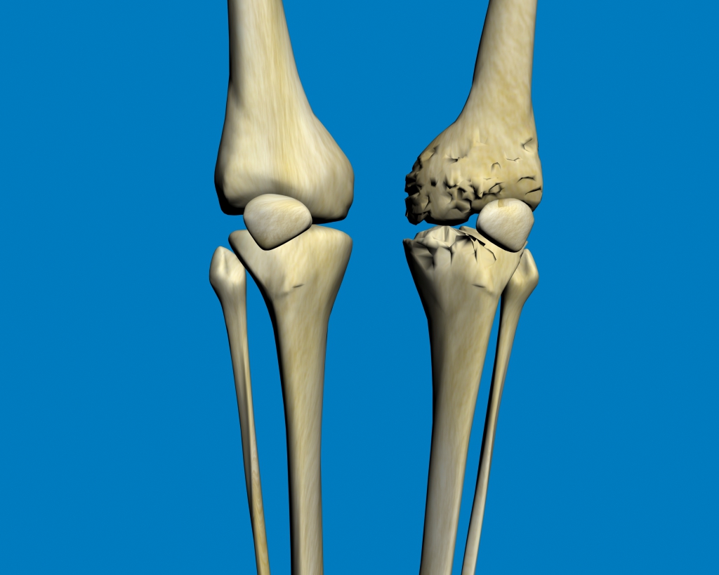 Recomendaciones para la artrosis o desgaste articular