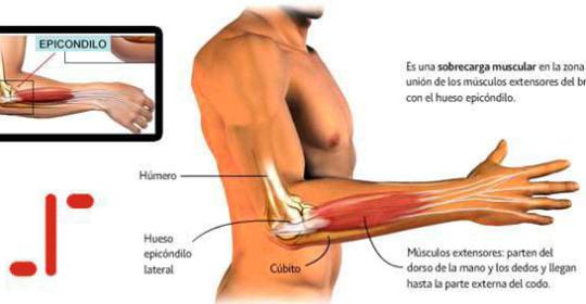 LA EPICONDILITIS O “CODO DE TENISTA”.