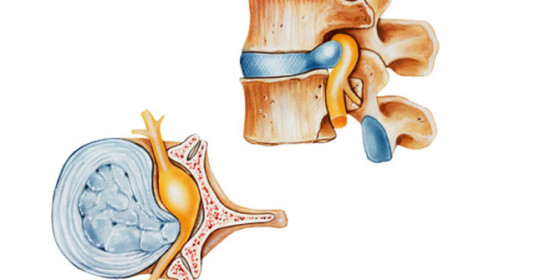 Causas de Hernia discal lumbar entre la L4 y L5 o cuarta y quinta vértebras lumbares.