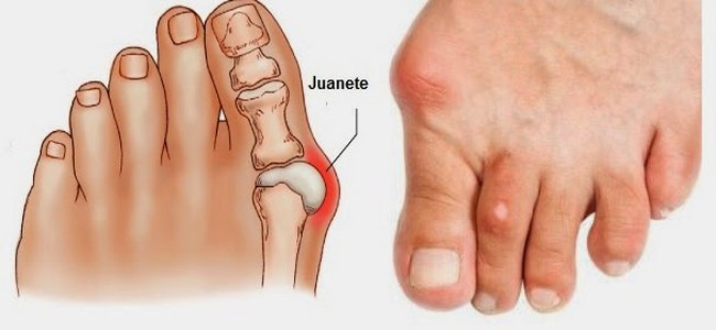 Ejercicios estiramientos y consejos para tratar el Halux valgus o Juanete.