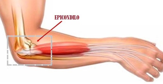 Epicondilitis y su relación con la zona cervical o vértebras cervicales