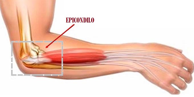 Epicondilitis y su relación con la zona cervical o vértebras cervicales